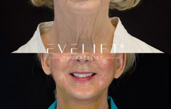 female patient before and after EVELIFT®