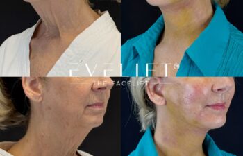 female patient before and after EVELIFT®