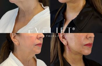 female patient before and after EVELIFT®