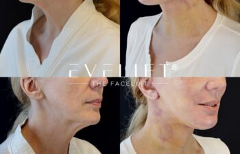 female patient before and after EVELIFT®