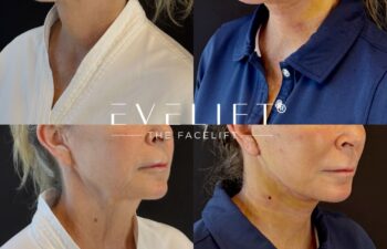 female patient before and after EVELIFT®