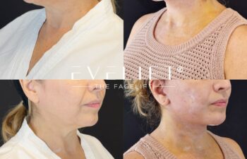 female patient before and after EVELIFT®