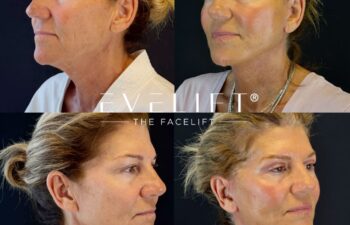 female patient before and after EVELIFT®