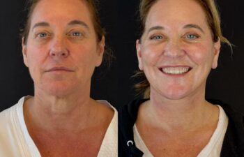 female patient before and after EVELIFT®