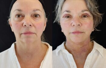 female patient before and after EVELIFT®