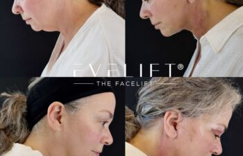 female patient before and after EVELIFT®