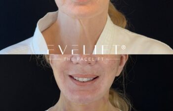 female patient before and after EVELIFT®