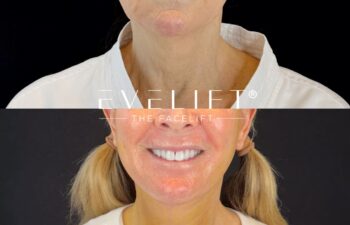 female patient before and after EVELIFT®