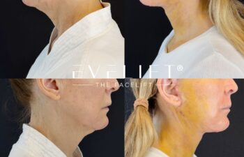 female patient before and after EVELIFT®