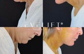 female patient before and after EVELIFT®