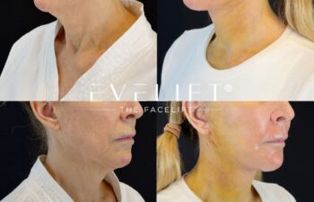female patient before and after EVELIFT®