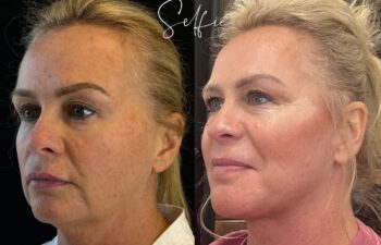 female patient before and after EVELIFT®