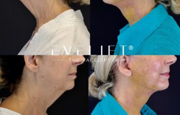 female patient before and after EVELIFT®