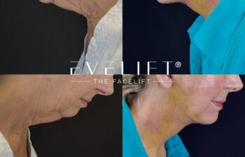 female patient before and after EVELIFT®