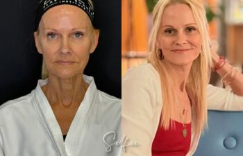 female patient before and after EVELIFT®