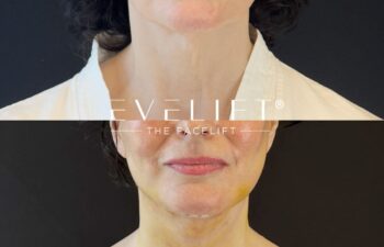 female patient before and after EVELIFT®