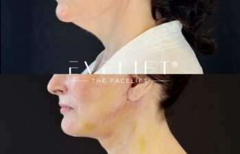 female patient before and after EVELIFT®