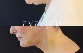 female patient before and after EVELIFT®
