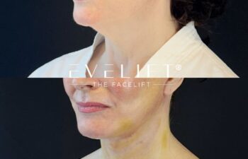 female patient before and after EVELIFT®