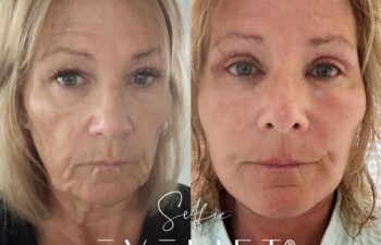 female patient before and after EVELIFT®