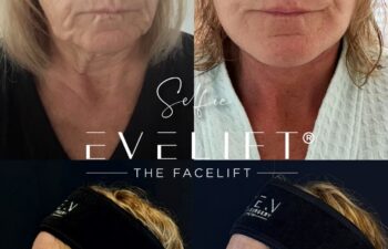 female patient before and after EVELIFT®