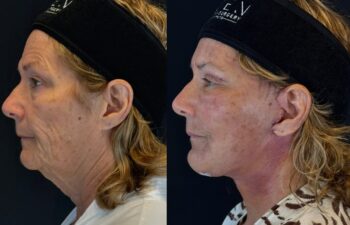 female patient before and after EVELIFT®