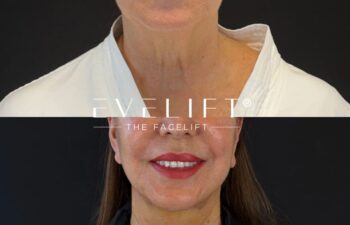 female patient before and after EVELIFT®