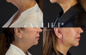 female patient before and after EVELIFT®