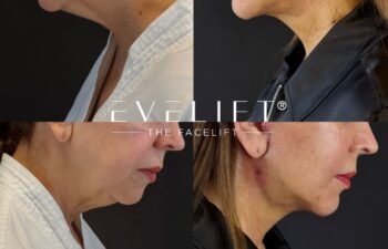 female patient before and after EVELIFT®