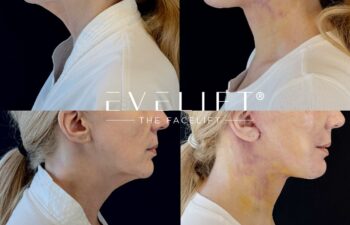 female patient before and after EVELIFT®