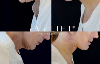 female patient before and after EVELIFT®