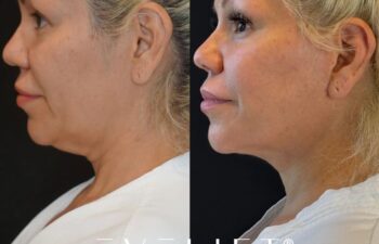 female patient before and after EVELIFT®