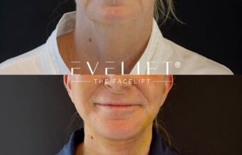 female patient before and after EVELIFT®