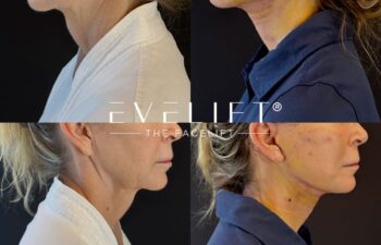 female patient before and after EVELIFT®