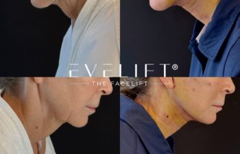 female patient before and after EVELIFT®