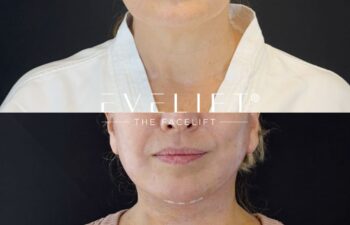female patient before and after EVELIFT®
