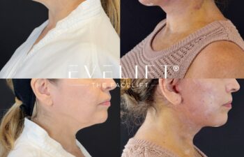 female patient before and after EVELIFT®