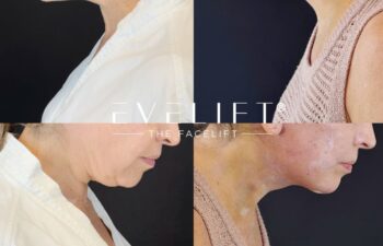 female patient before and after EVELIFT®