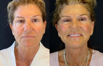 female patient before and after EVELIFT®