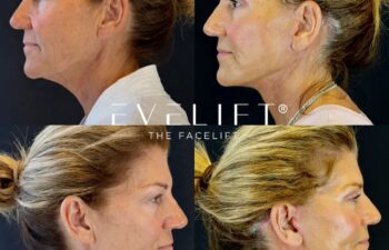 female patient before and after EVELIFT®