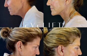 female patient before and after EVELIFT®