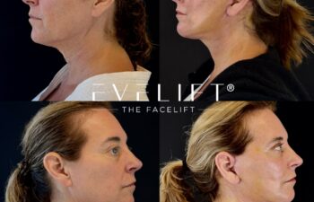 female patient before and after EVELIFT®