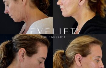 female patient before and after EVELIFT®