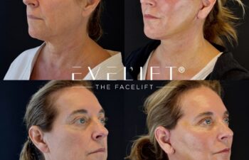 female patient before and after EVELIFT®