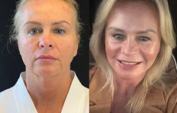 female patient before and after EVELIFT®