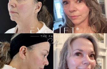 female patient before and after EVELIFT®