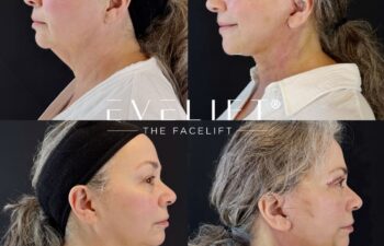 female patient before and after EVELIFT®