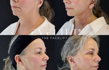 female patient before and after EVELIFT®
