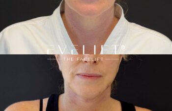 female patient before and after EVELIFT®