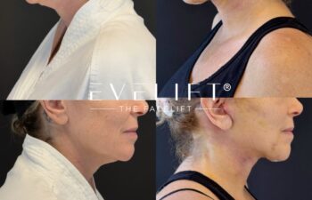 female patient before and after EVELIFT®
